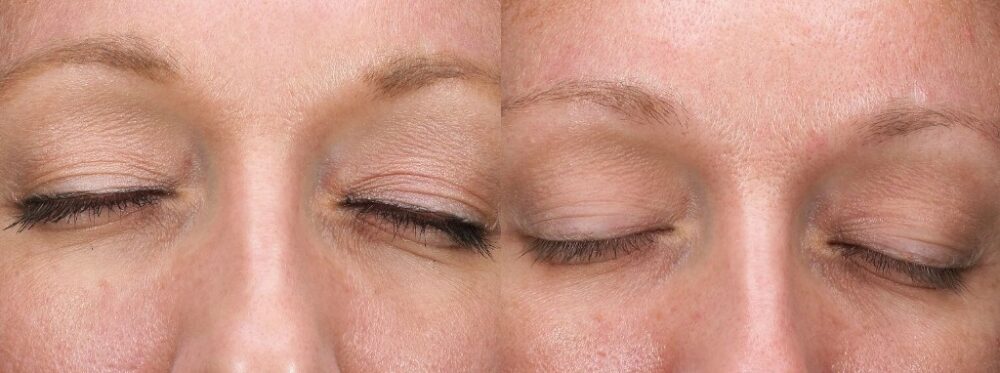 Thermage treatment before and after photo