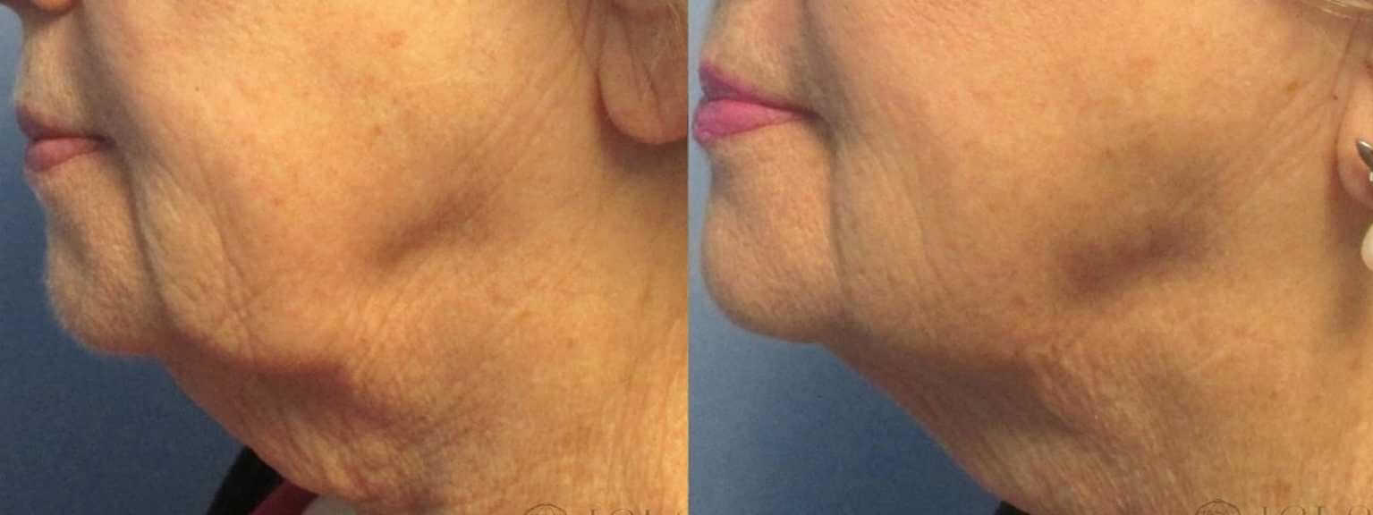 Ultherapy treatment before and after photo