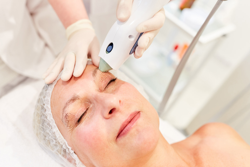 Woman getting eyelid lift by Thermage