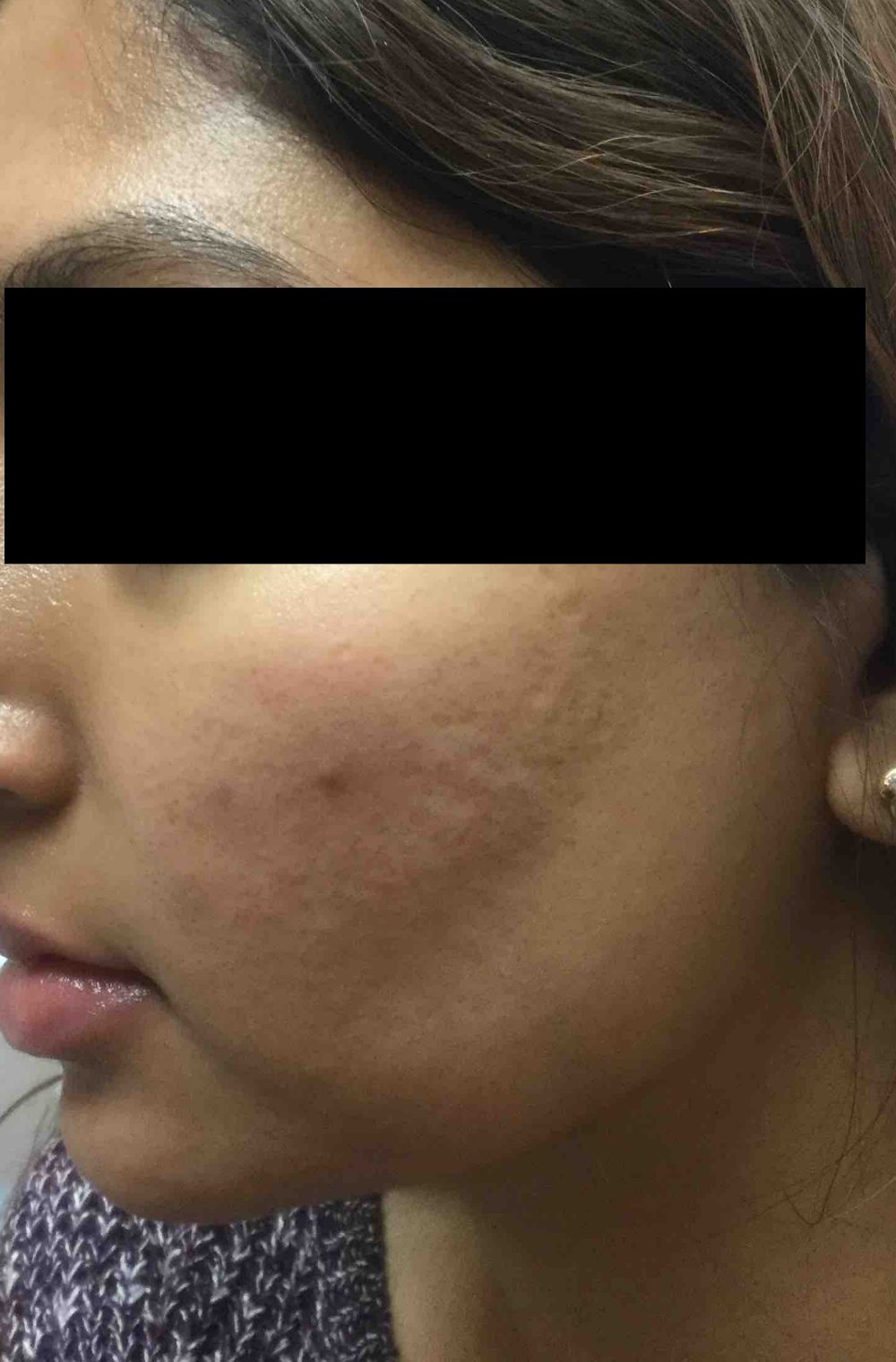 Starwalker Acne Scarring After Photo