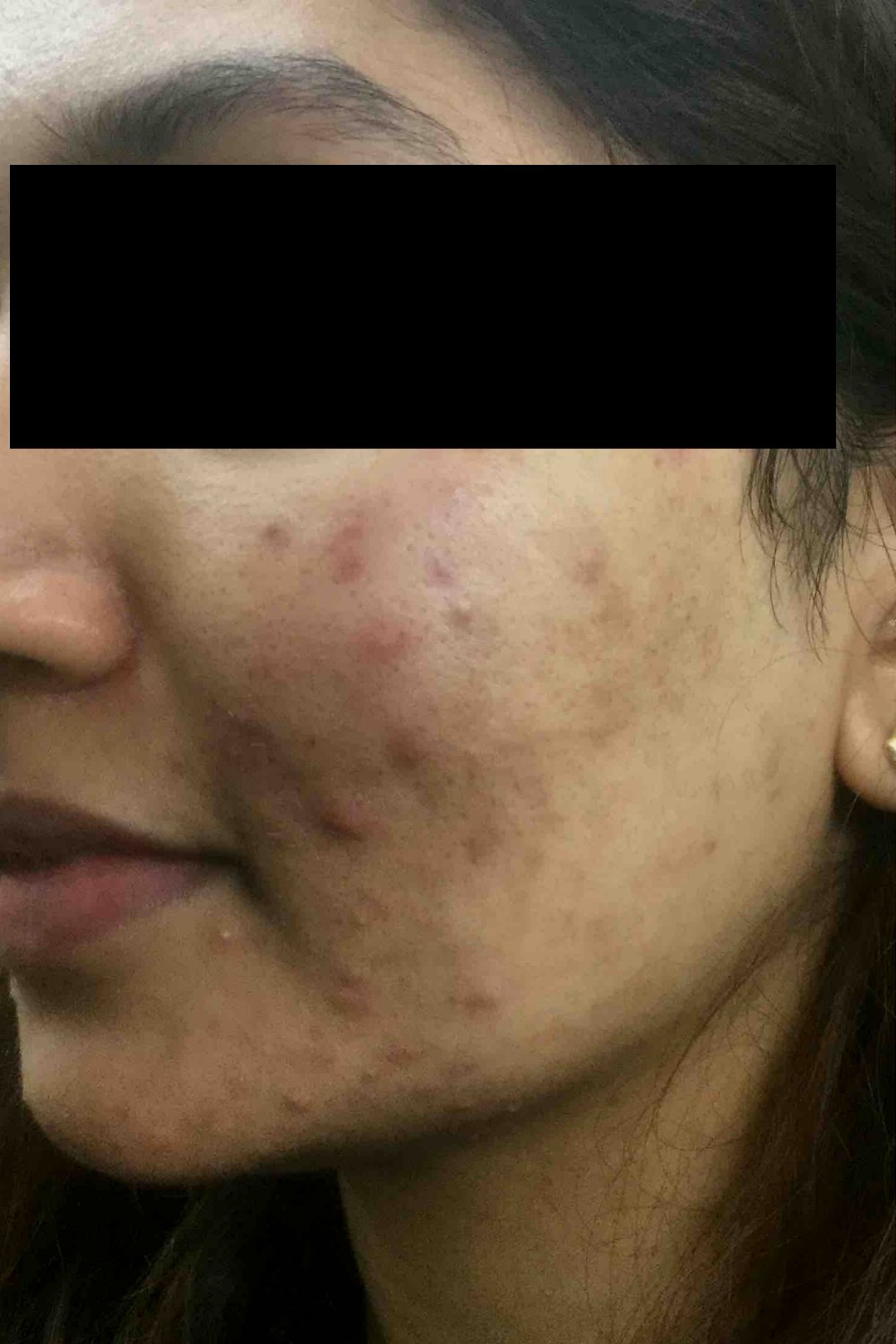 Starwalker Acne Scarring Before Photo