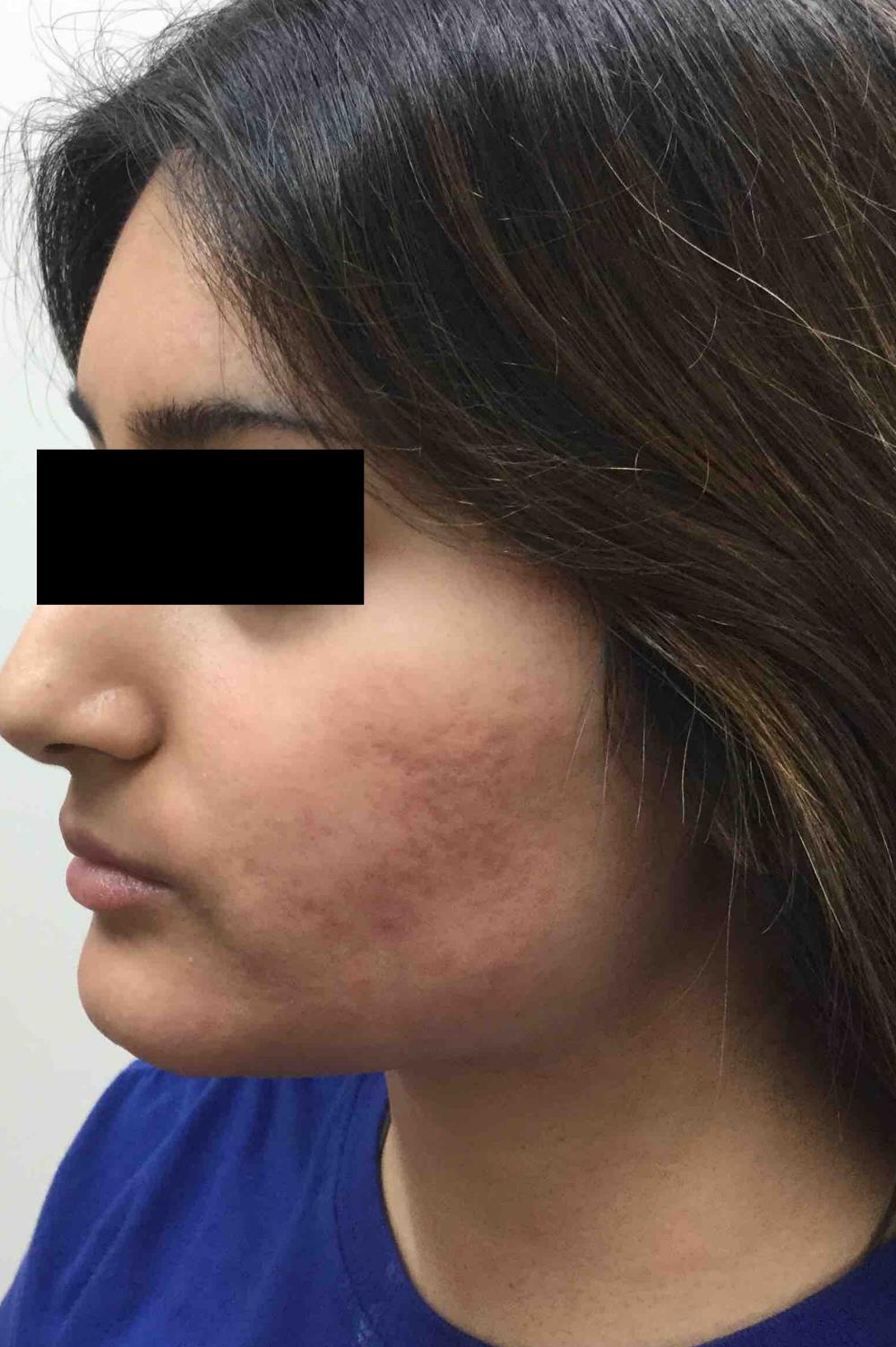 Starwalker Acne Scarring Before