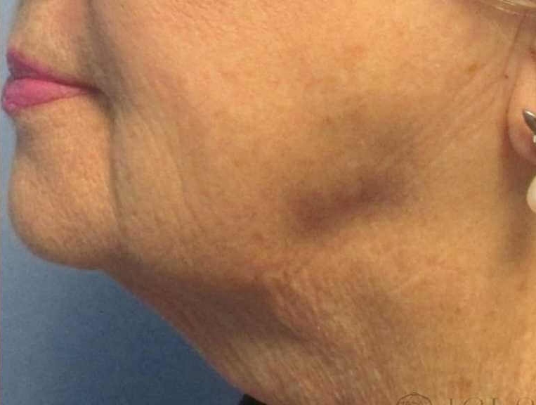 Ultherapy after photo