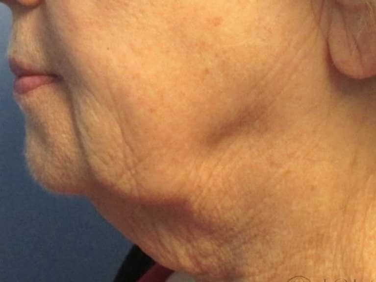 Ultherapy before photo