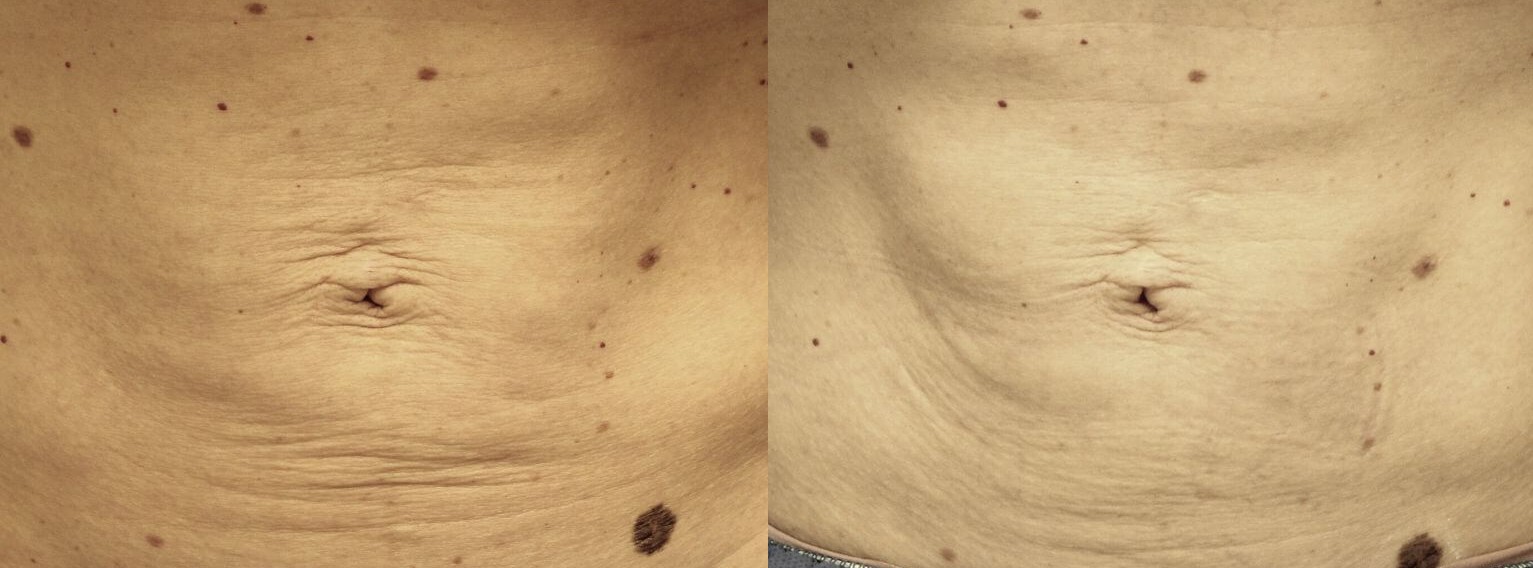 Skin Tightening using Profound Dermal Tightening Treatment.