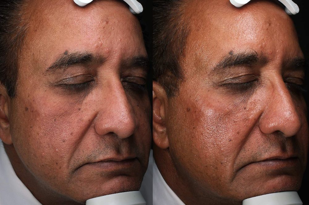 Side-by-side comparison of a man's face before and after Skinvive treatment, showing noticeable improvement in skin texture and hydration.