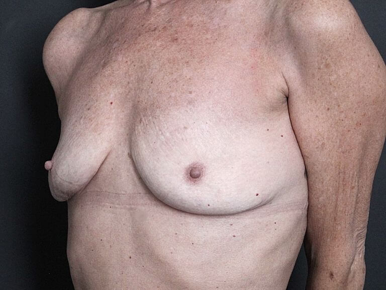 Photo 2 of After Breast Implant Removal in Toronto.