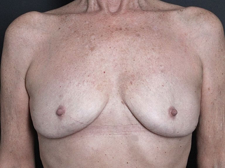 Photo 4 of After Breast Implant Removal in Toronto.