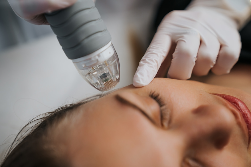 Microneedling treatment being applied to a woman’s face for enhanced skin rejuvenation and collagen stimulation.