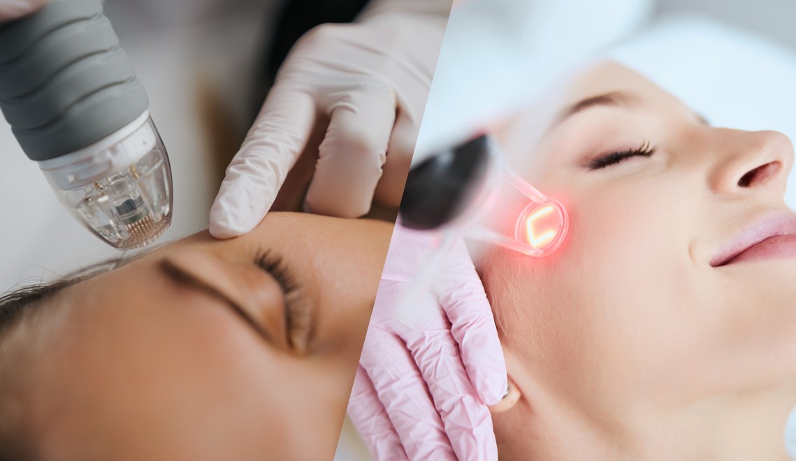 Comparison of microneedling and laser treatments for skin rejuvenation, showcasing their distinct approaches to enhancing skin texture and tone.