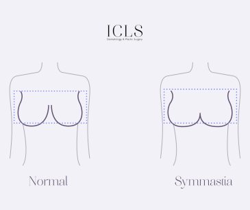 Illustration showing a comparison between normal breast anatomy and symmastia, highlighting the absence of cleavage in symmastia.