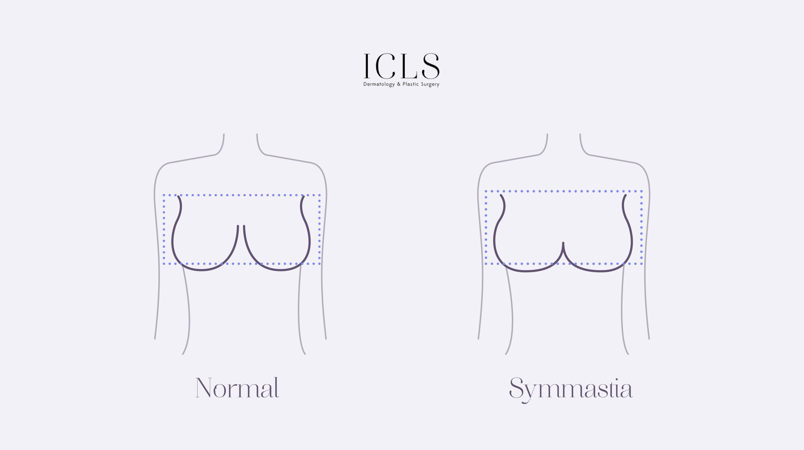 Illustration showing a comparison between normal breast anatomy and symmastia, highlighting the absence of cleavage in symmastia.